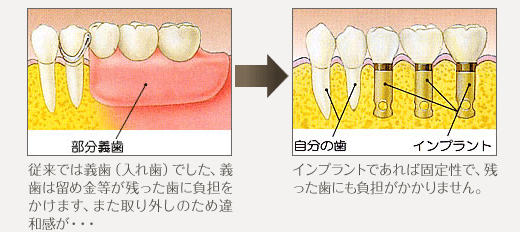 従来では義歯（入れ歯）でした、義歯は留め金等が残った歯に負担をかけます、また取り外しのため違和感が・・・インプラントであれば固定性で、残った歯にも負担がかかりません。