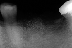 抜歯時に骨補填材を抜歯窩に填足します、その上に隔離膜を設置する事もあります。