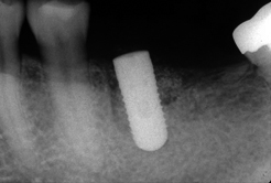 その後、抜歯窩の治癒を待ちインプラントを埋入。抜歯による骨の喪失も最小限に押さえられました。