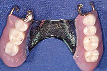 テレスコープ義歯症例
