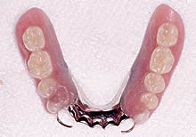 磁性アタッチメント義歯（磁石義歯）