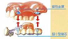 磁性アタッチメント義歯（磁石義歯
