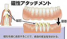 磁性アタッチメント義歯（磁石義歯