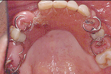 磁石義歯症例２（総義歯タイプ）