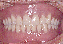 磁石義歯症例２（総義歯タイプ）